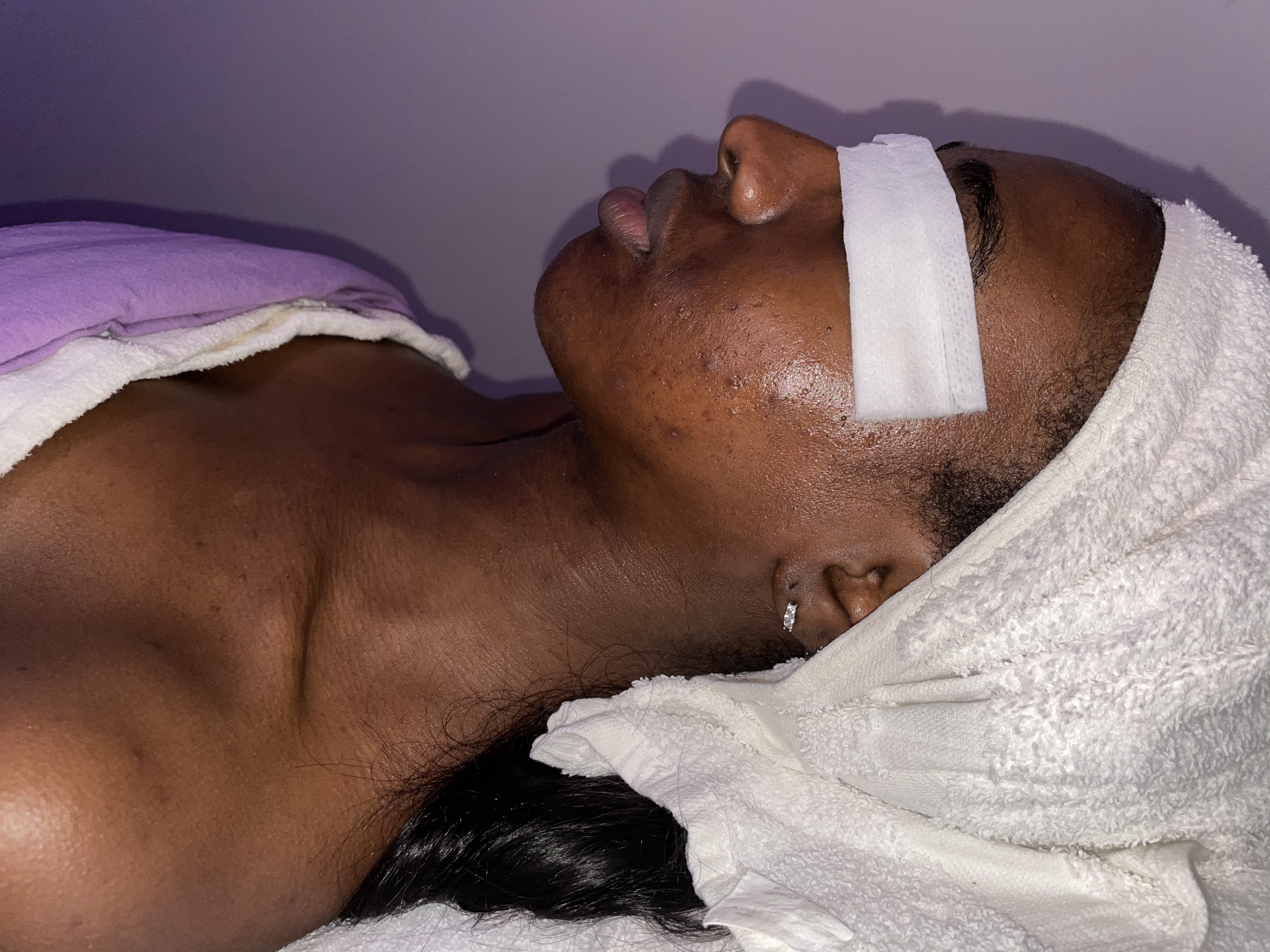 What Is A Microdermabrasion Treatment?